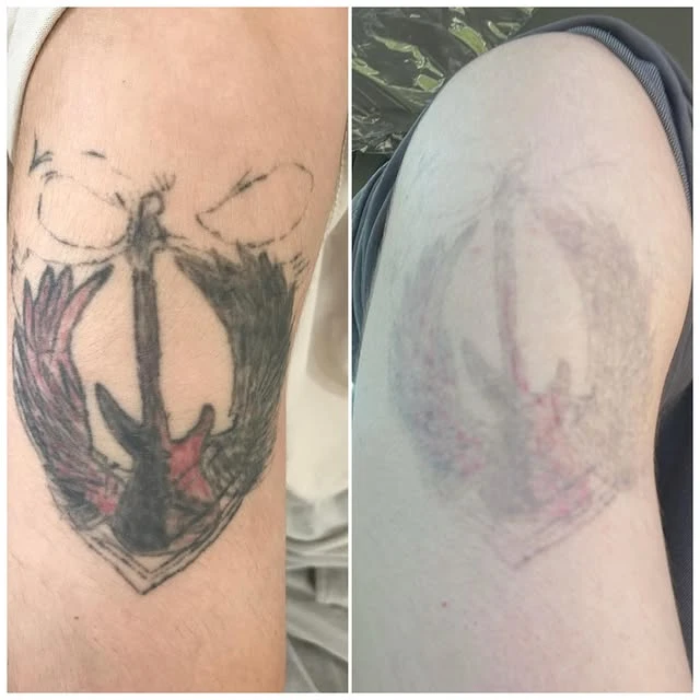 Black tattoo removal before and after photo