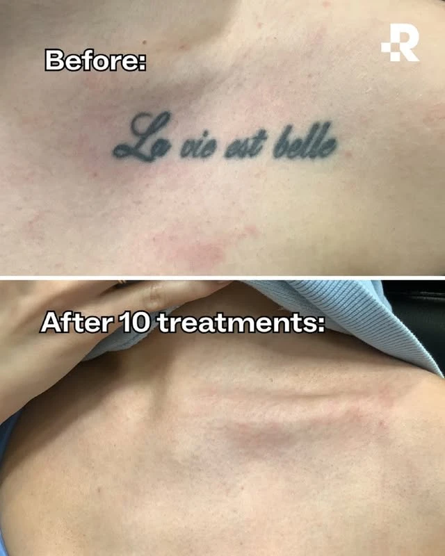 Black tattoo removal before and after 10 sessions photo