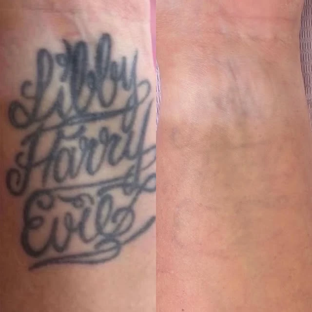 Red tattoo removal before and after photo