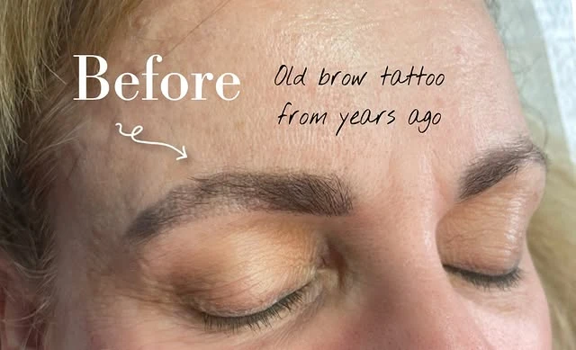 Blue tattoo removal before and after photo
