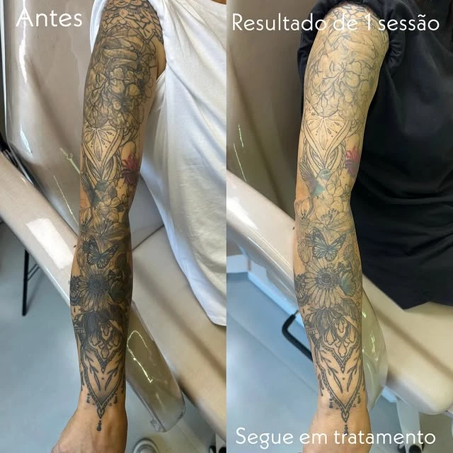 Black tattoo removal before and after photo