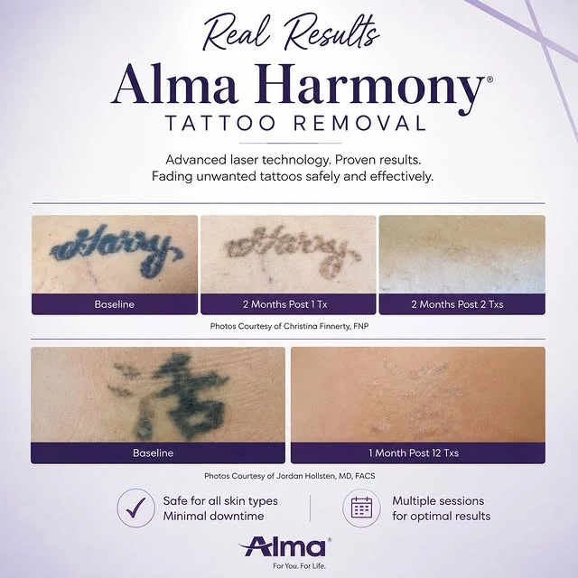 Black tattoo removal before and after photo