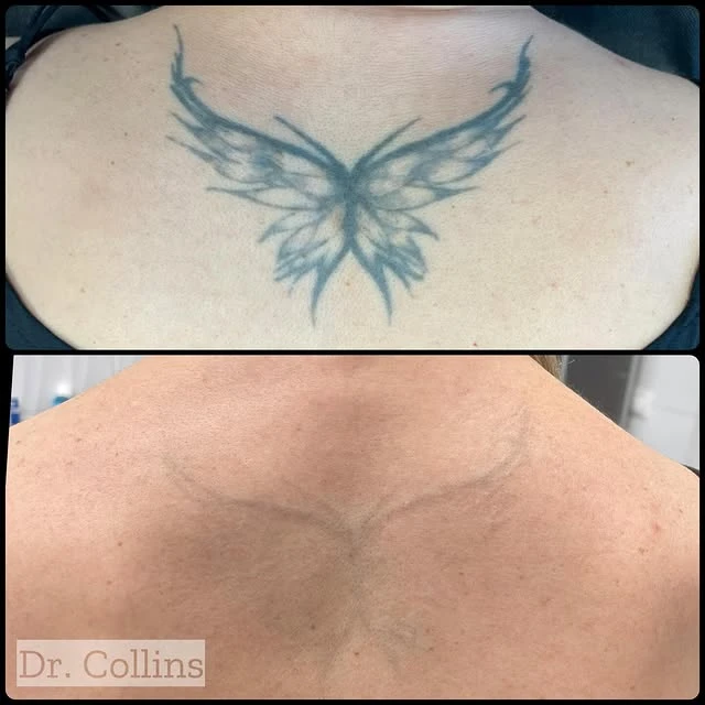 Black tattoo removal before and after photo