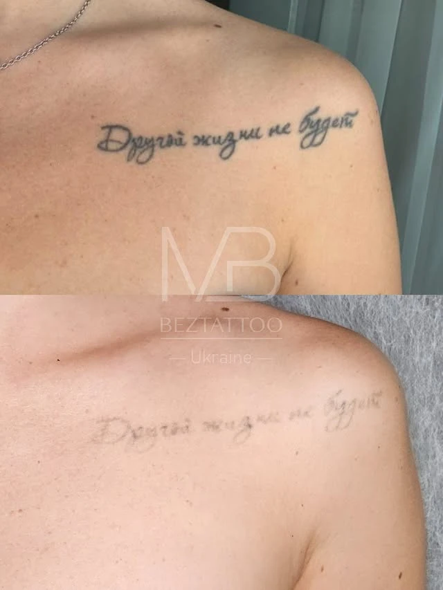 Black tattoo removal before and after photo