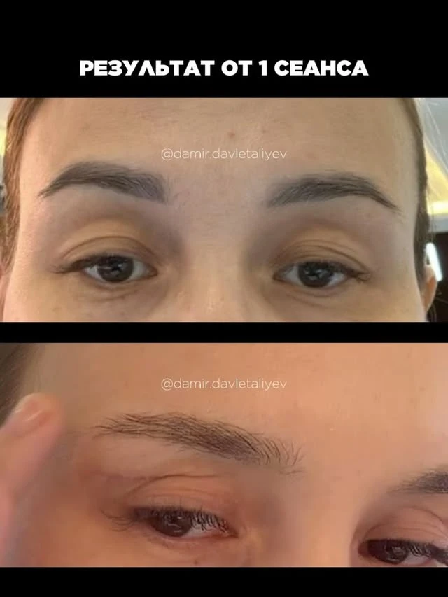 Black tattoo removal before and after photo