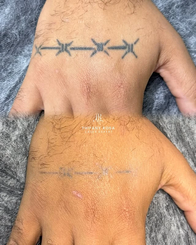 Black tattoo removal before and after photo