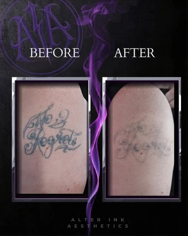 Black tattoo removal before and after photo