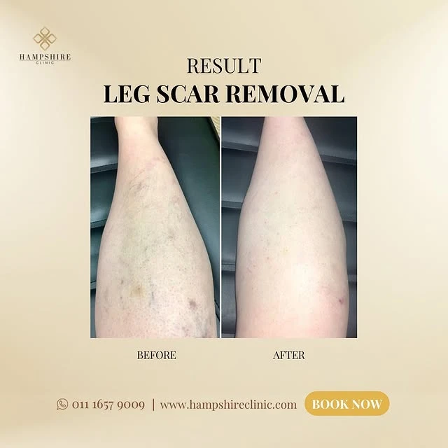 Red tattoo removal before and after photo