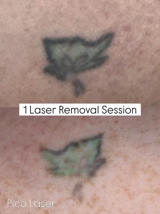 White tattoo removal before and after photo