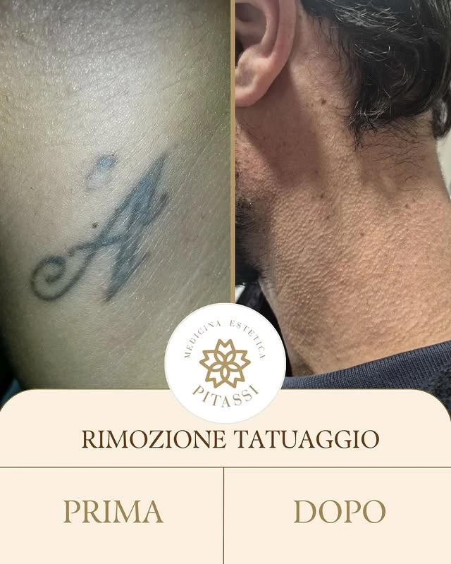 Black tattoo removal before and after photo