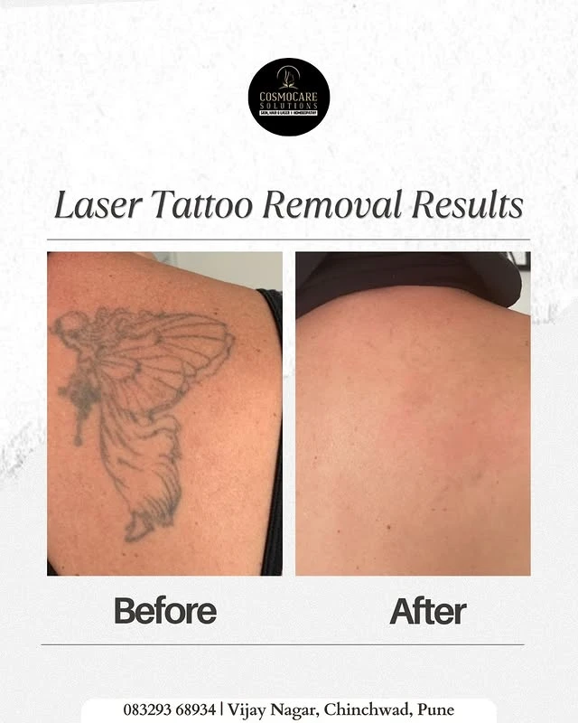 Black tattoo removal before and after photo