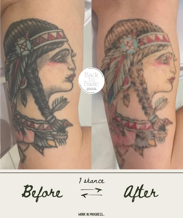 Black tattoo removal before and after photo