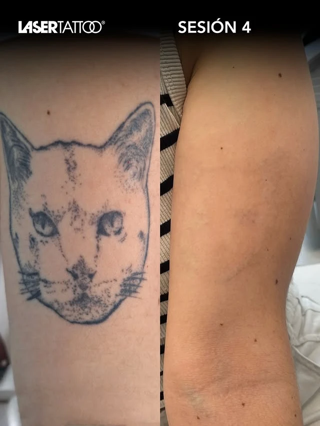 Black tattoo removal before and after photo