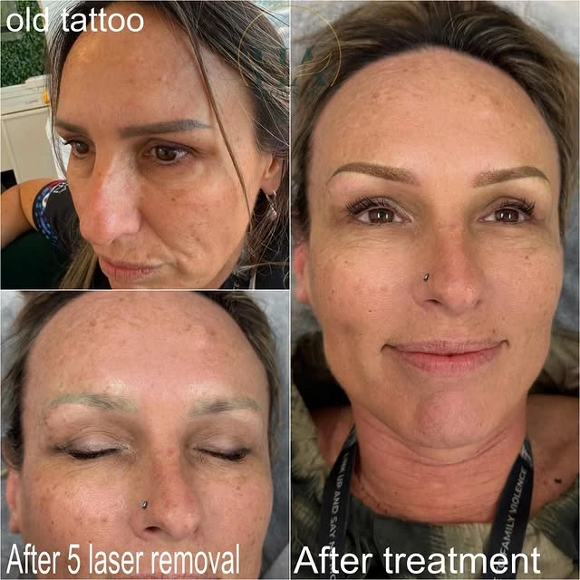 Green tattoo removal before and after photo