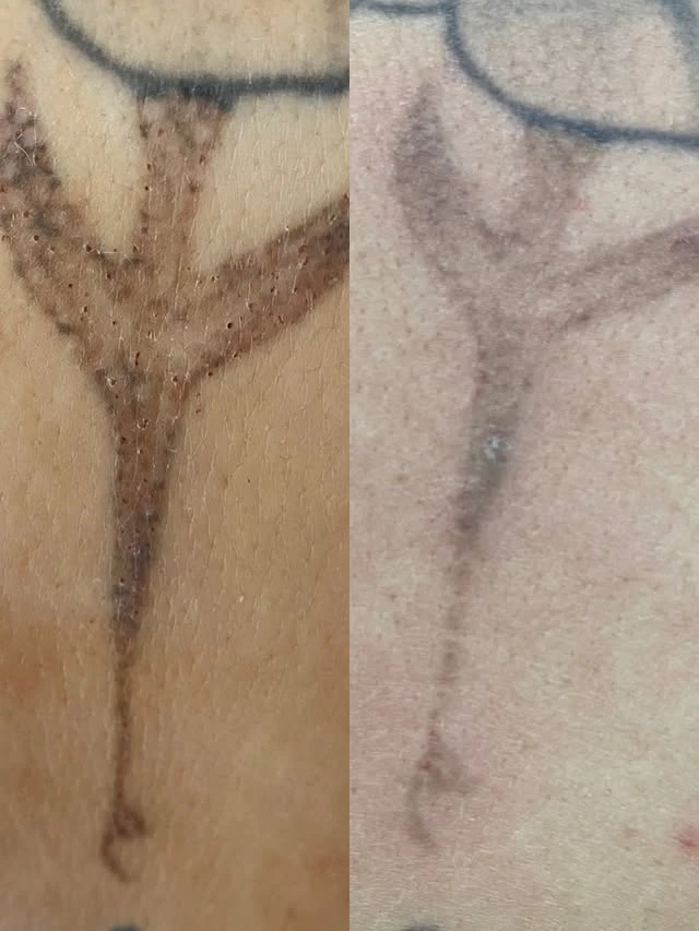 Black tattoo removal before and after photo