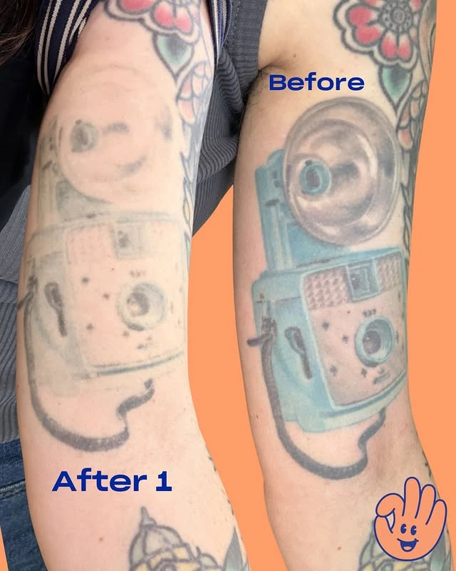 Black tattoo removal before and after 1 sessions photo